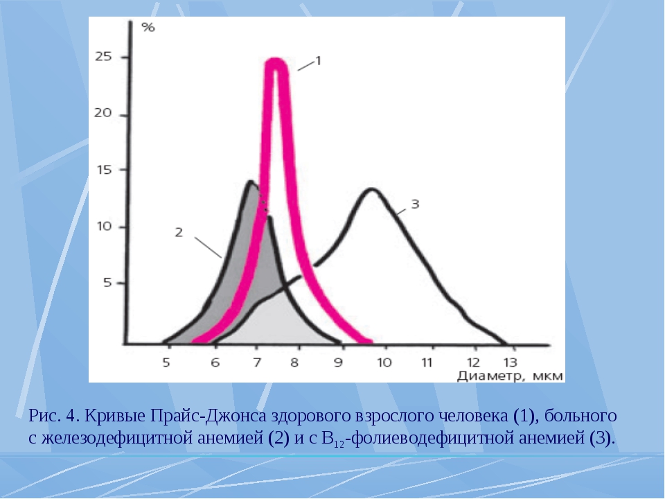 Метод джонсона. Кривая прайс Джонса. Эритроцитометрическая кривая. Эритроцитометрические кривые прайс-Джонса. Эритроцитарная гистограмма.